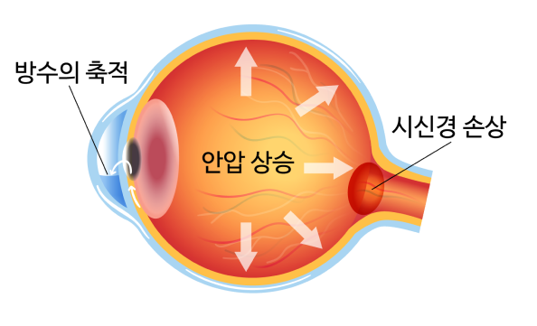 녹내장 진단 방법